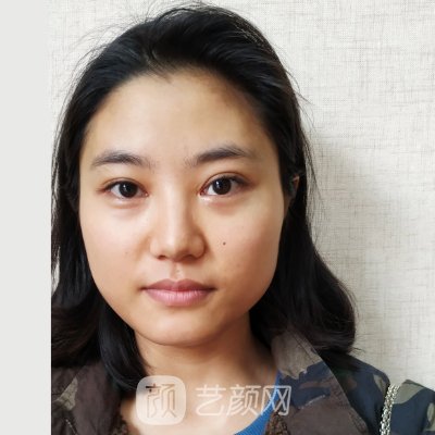 上海伊莱美医疗美容医院口碑怎么样?崭新隆鼻实例出炉