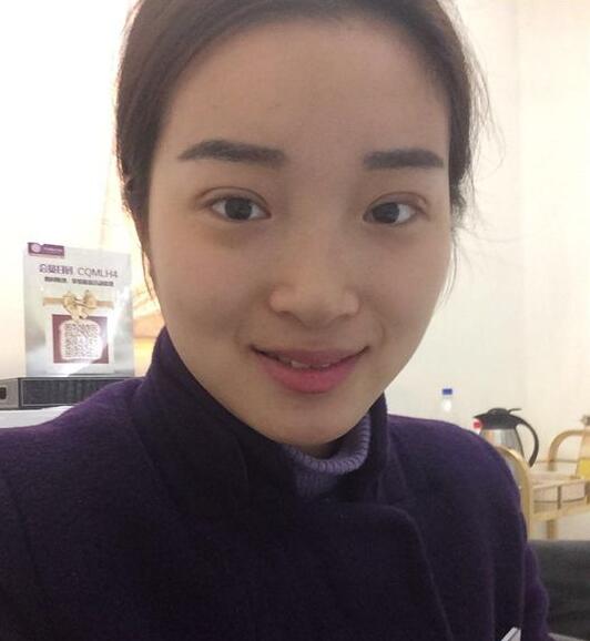 深圳阳光医院双眼皮一个月恢复图 日记见证蜕变