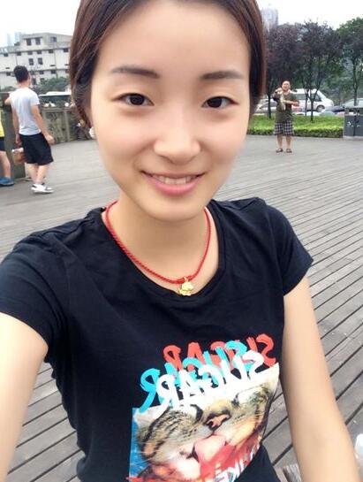 深圳阳光医院双眼皮一个月恢复图 日记见证蜕变