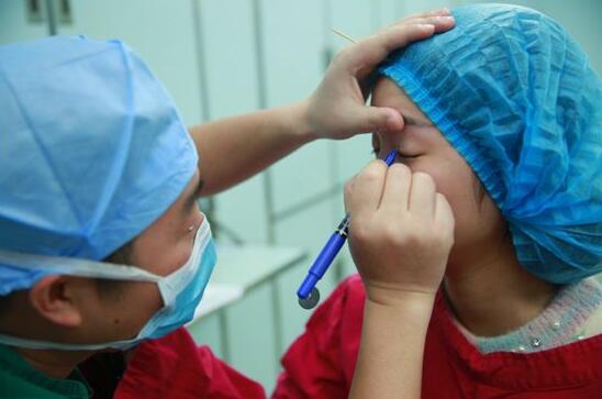 深圳阳光医院双眼皮一个月恢复图 日记见证蜕变