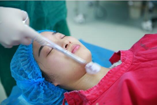 深圳阳光医院双眼皮一个月恢复图 日记见证蜕变