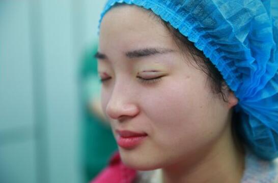 深圳阳光医院双眼皮一个月恢复图 日记见证蜕变