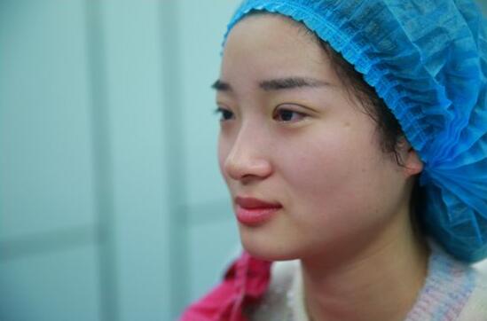 深圳阳光医院双眼皮一个月恢复图 日记见证蜕变