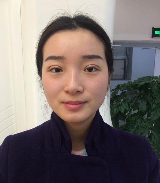 深圳阳光医院双眼皮一个月恢复图 日记见证蜕变