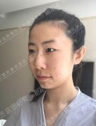 青岛伊美尔割双眼皮多少钱？刘长发案例分享~