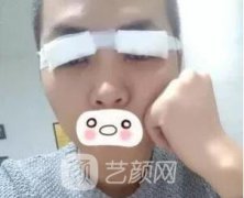 爱思特张姣姣双眼皮案例照片日记 男生也会做双眼皮手术哦