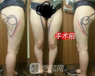 东莞缔美陈星光大腿吸脂照片 内附全部恢复过程体验