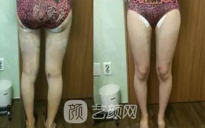 东莞缔美陈星光大腿吸脂照片 内附全部恢复过程体验