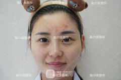 南京施尔美微针美塑祛痘真人体验果图片案例