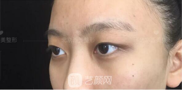 北京西美整形医院全切双眼皮真人案例图|内附恢复过程哦~