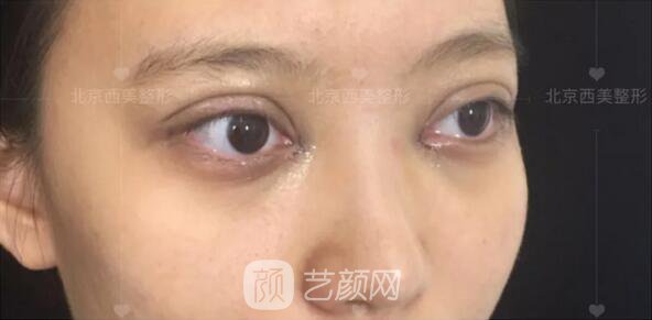 北京西美整形医院全切双眼皮真人案例图|内附恢复过程哦~