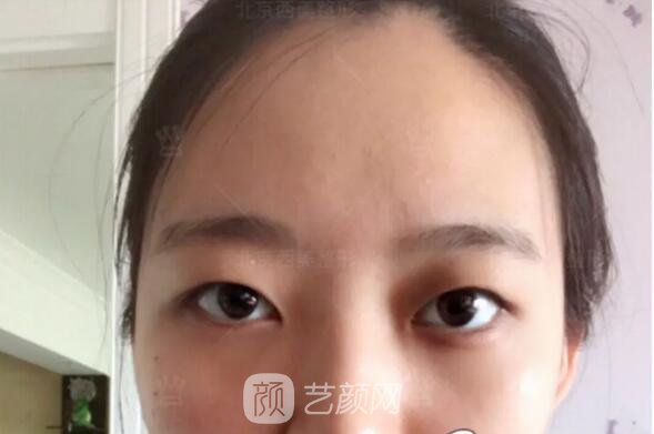 北京西美整形医院全切双眼皮真人案例图|内附恢复过程哦~