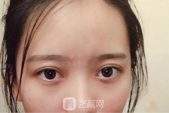 北京西美整形医院全切双眼皮真人案例图|内附恢复过程哦~