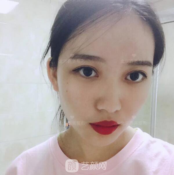 北京西美整形医院全切双眼皮真人案例图|内附恢复过程哦~