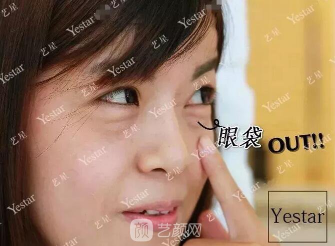 北京艺星整形Yestar分龄祛眼袋真实案例图分享哦~