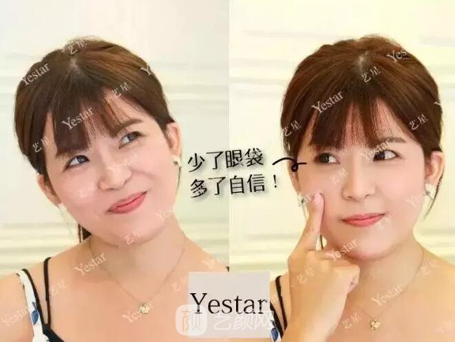 北京艺星整形Yestar分龄祛眼袋真实案例图分享哦~