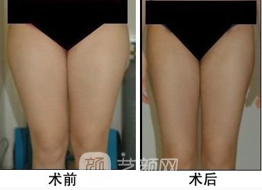 腿部曲线蜕变