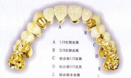 贵金属烤瓷牙的价格大概是多少?