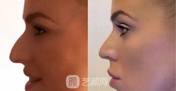 北京自体肋软骨隆鼻费用是多少