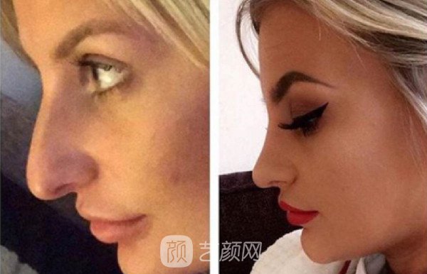 北京自体肋软骨隆鼻费用是多少