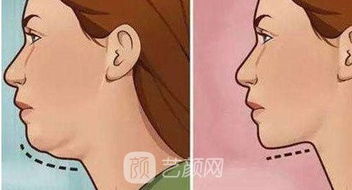 深圳磨尖下巴骨多少钱？