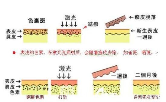 光子嫩肤去毛孔和黑头