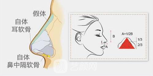上海耳软骨垫鼻尖多少钱?