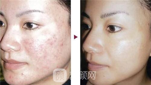 上海像素激光祛痘价格?