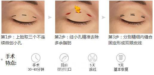 上海韩式三点双眼皮价格多少?