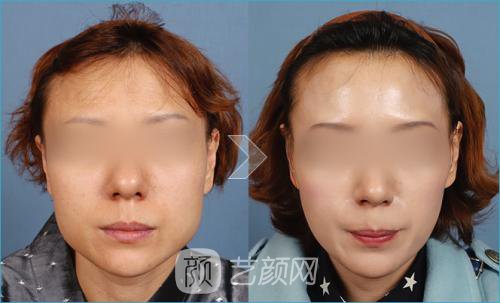 【北京磨腮骨大概多少钱?】