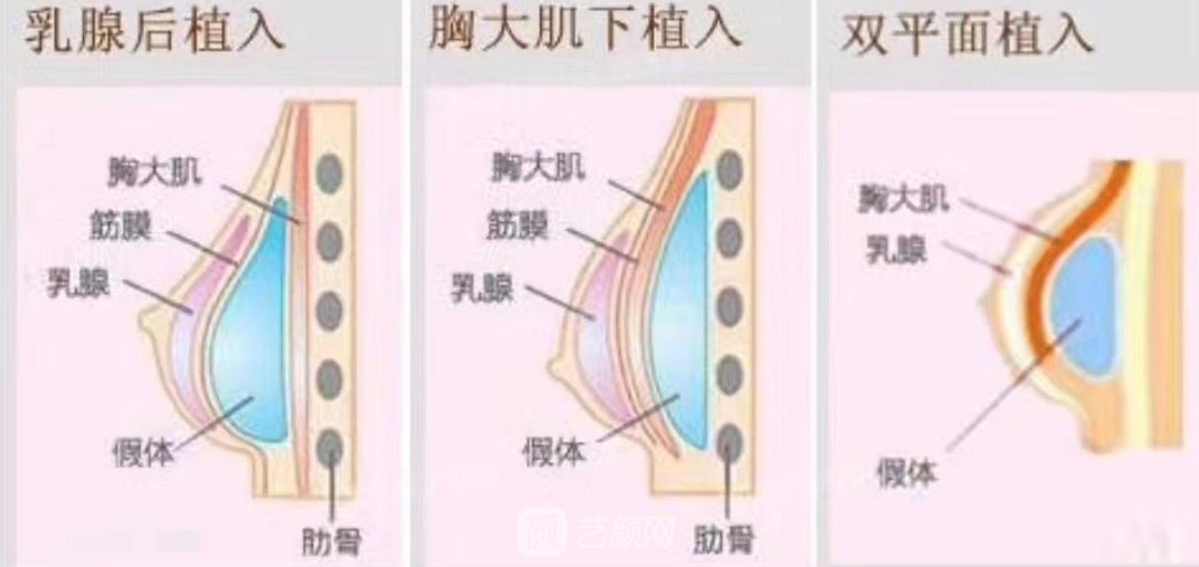 双平面丰胸果好吗?双平面丰胸果图~