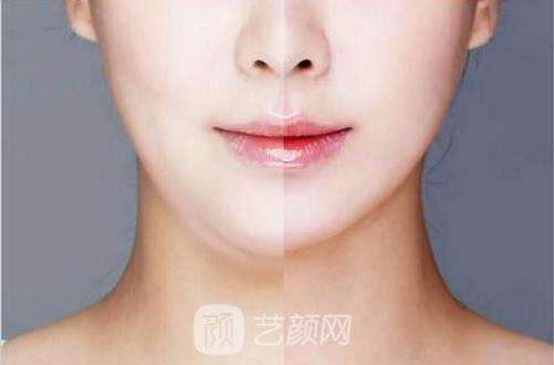 去颊脂垫和吸脂哪个好?