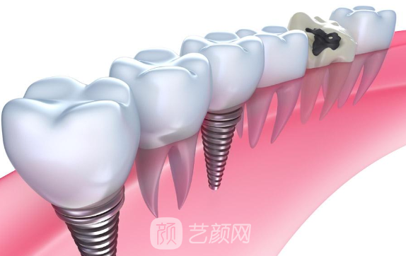 种植牙费用多少