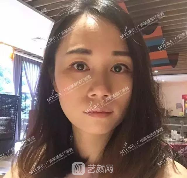 广州美莱玻尿酸全脸填充果照片分享~