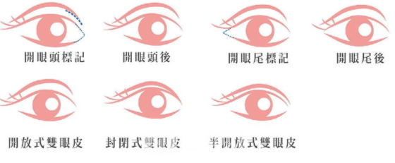割双眼皮修复要多少钱
