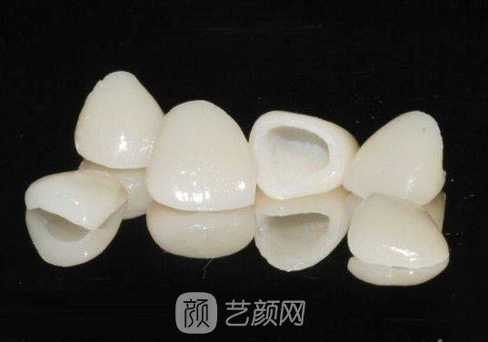 【烤瓷牙植牙多少钱？】