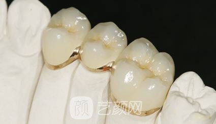 烤瓷牙价格多少