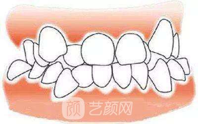 金钯合金烤瓷牙价格多少?