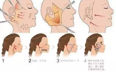 成都热玛吉拉皮除皱多少钱?