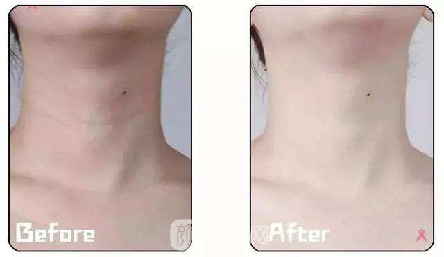 成都热玛吉拉皮除皱多少钱?