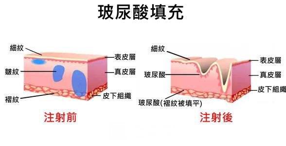 注射玻尿酸没问题吗?