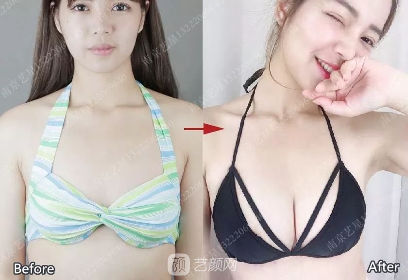 南京艺星自体脂肪丰胸术一个月案例分享~