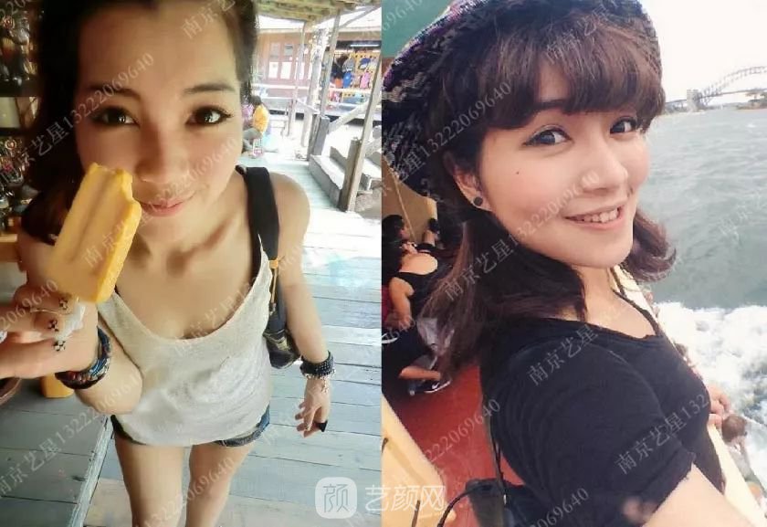 南京艺星自体脂肪丰胸术一个月案例分享~