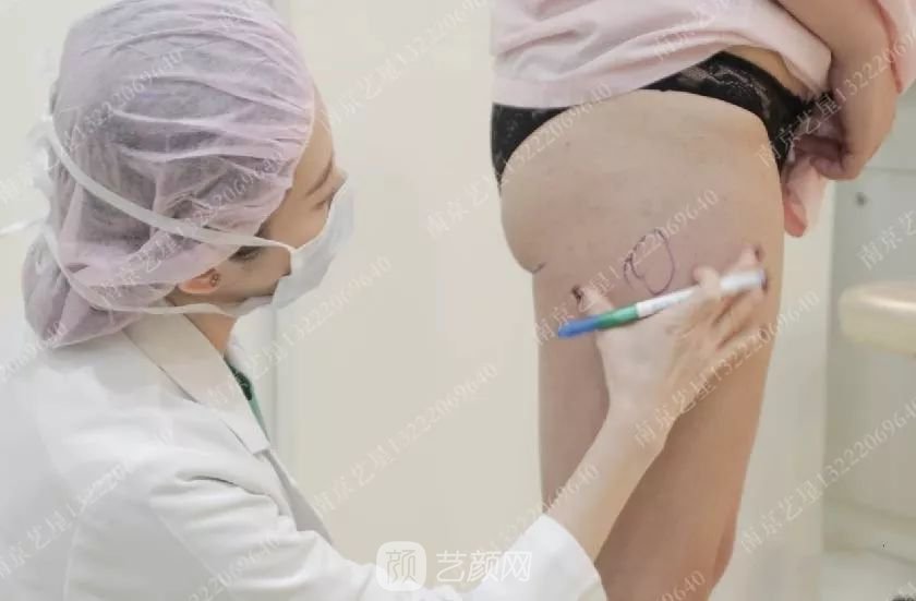 南京艺星自体脂肪丰胸术一个月案例分享~