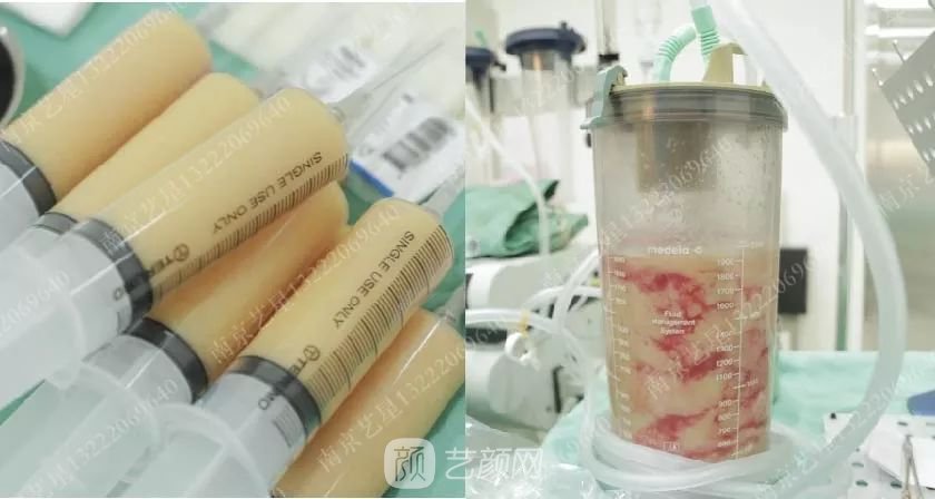 南京艺星自体脂肪丰胸术一个月案例分享~