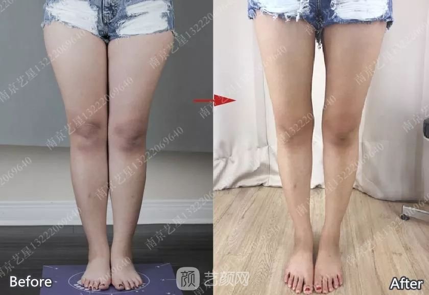 南京艺星自体脂肪丰胸术一个月案例分享~