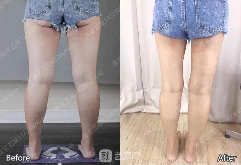 南京艺星自体脂肪丰胸术一个月案例分享~