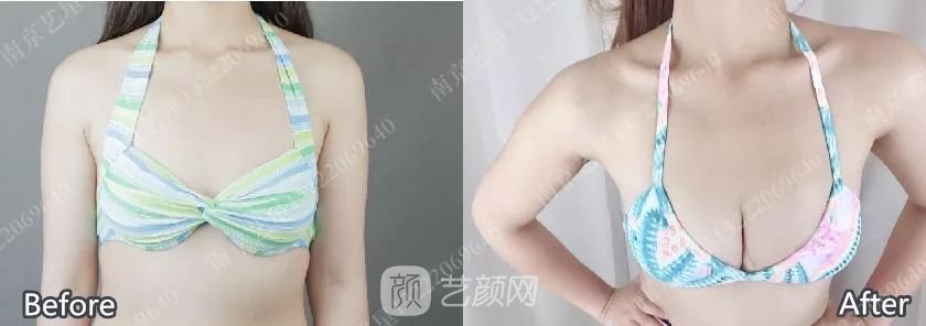 南京艺星自体脂肪丰胸术一个月案例分享~