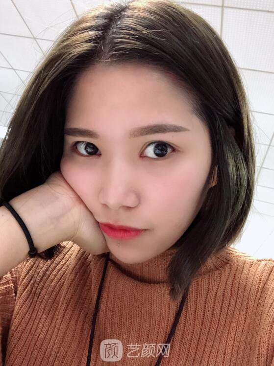 开眼角图真实案例分享哦