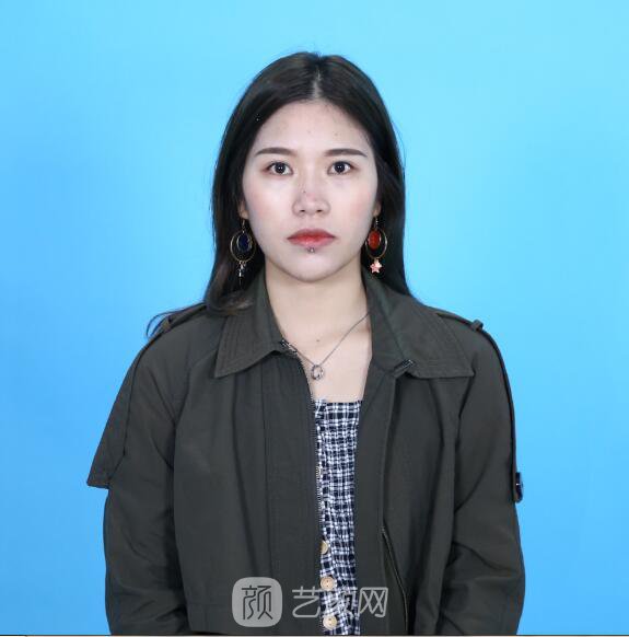 开眼角图真实案例分享哦